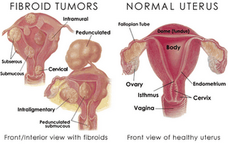 Image result for punca fibroid